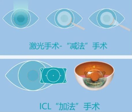 近视手术选择公立还是私立医院