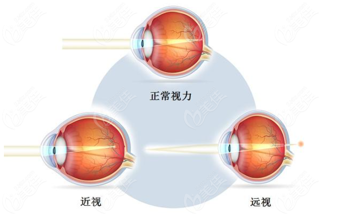 重庆近视眼手术