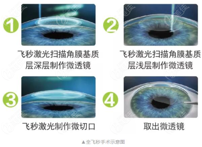 全飞秒激光近视手术过程236z.com