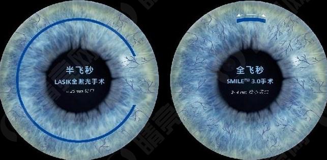 重庆近视手术价格一览表2023