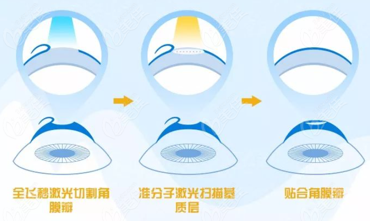 飞秒激光手术