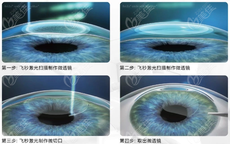 全飞秒近视手术图示