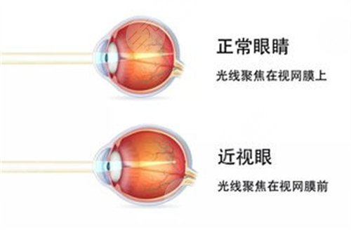 重庆近视手术大概多少费用