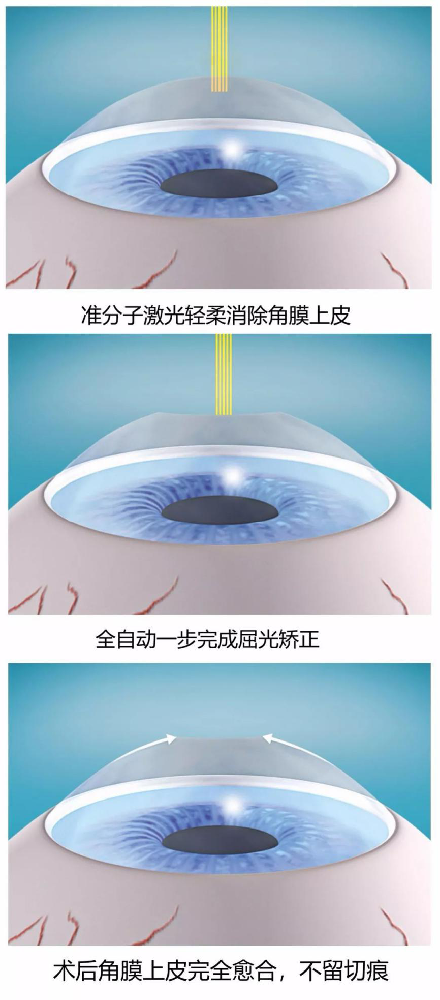 SMART全激光手术价格，手术怎么做的？