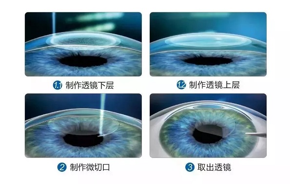 全飞秒手术价格多少钱?